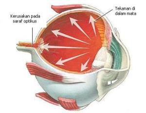 obat tradisiona glaukoma